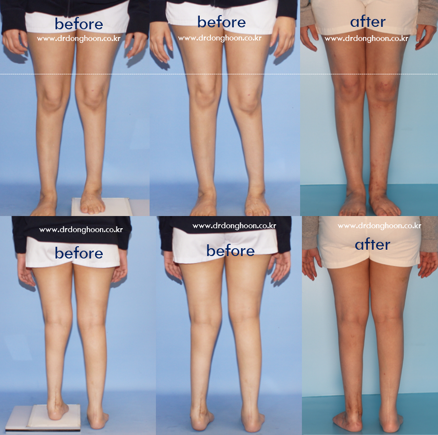 Post Traumatic Leg Length Discrepancy Patient From Uae Limb Lengthening Complex