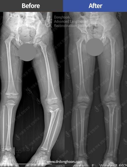 블라운트 병(Blount disease)으로 인한 하지부동 및 오다리를 치료