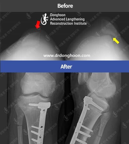 再発性膝蓋骨脱臼 – Limb Lengthening & Complex Reconstruction Service: Korea | DALRI