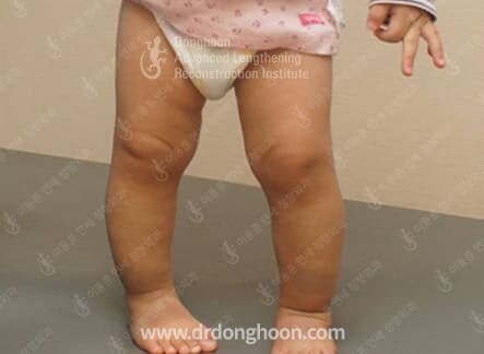 걸을 때 발이 안쪽을 향해 걷는 상태