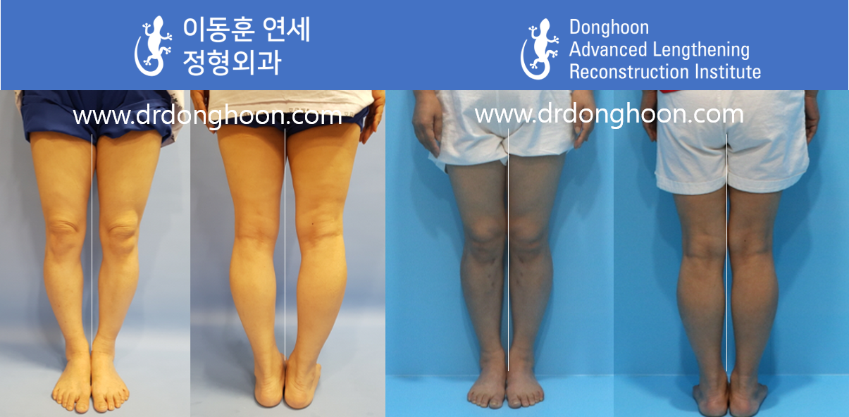 Deformity Correction: The Process  International Center for Limb