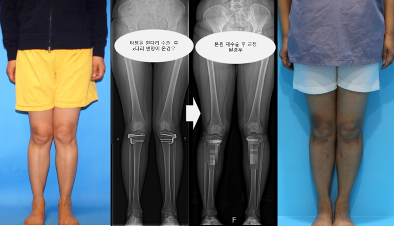 Reoperation Knock Knees Deformity After Bowlegs Correction At Another