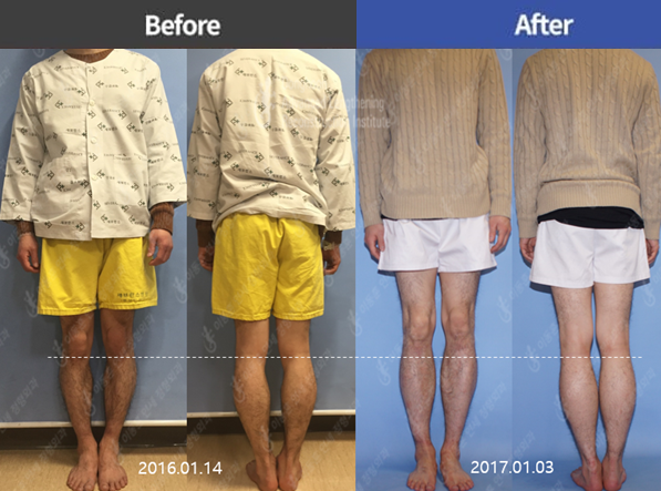 7cm Tibial Lengthening by LON method – Limb Lengthening & Complex ...