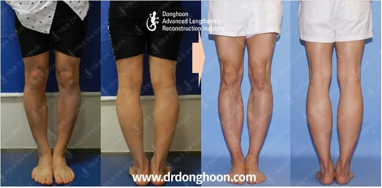 7cm Of Tibial Lengthening + Bowlegs Correction (LATN) – Limb ...