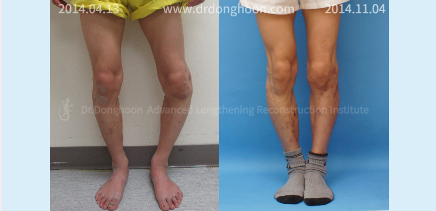 Congenital Rare Severe Leg Deformity 3 year post – op – Limb ...