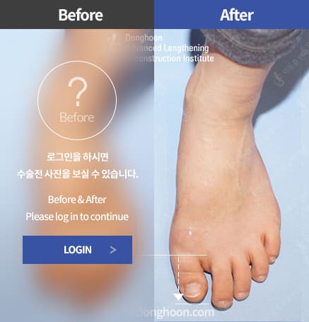 단지증